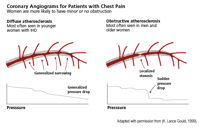 coronary Angiograms for pts with chest pain